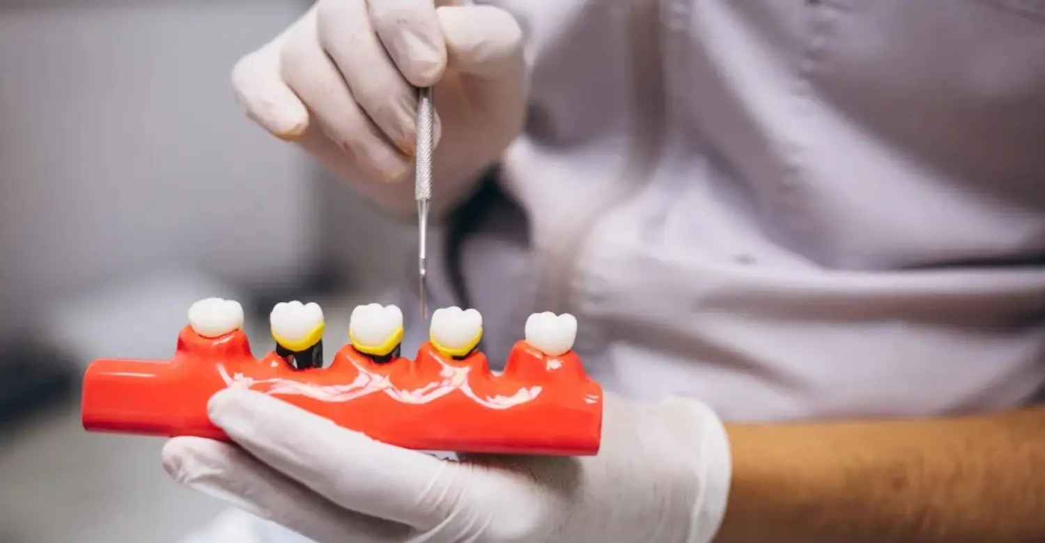 Same Day Crowns vs Lab Made Crowns 2